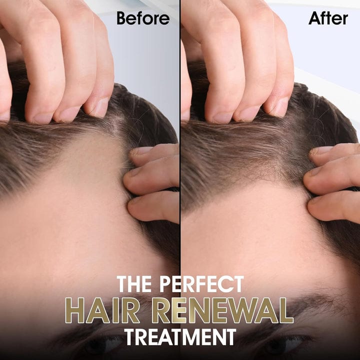 Derma Roller